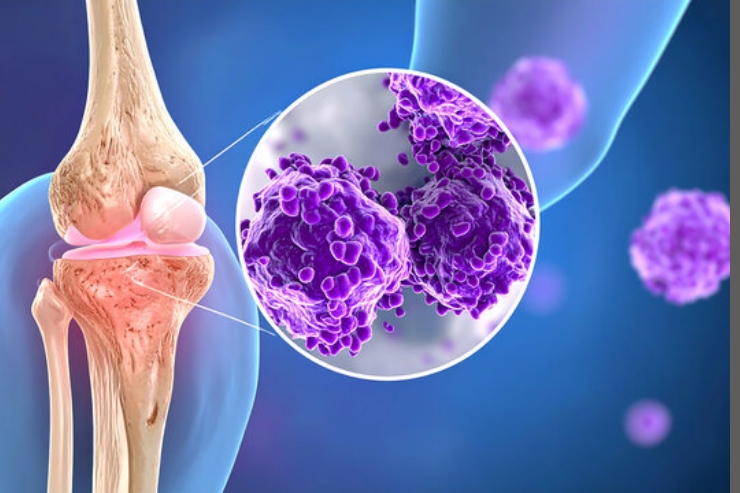 Autoimmune Conditions